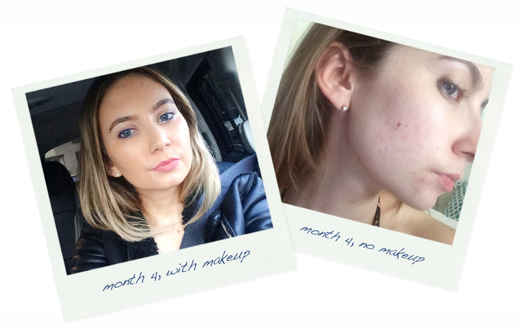 Accutane Skin Care Secret For Celebs Horror Story For Me E Online